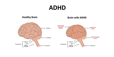 5 Simple Strategies To Help Your Adhd Child Achieve Success