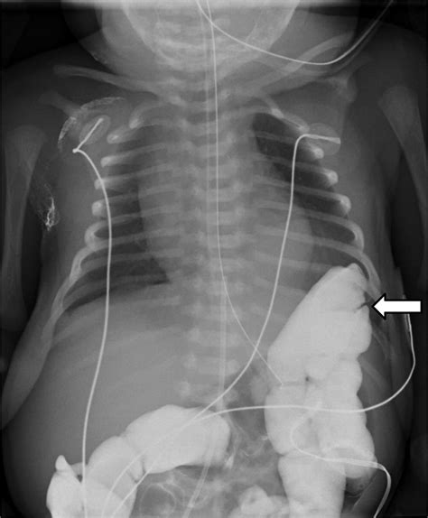 Congenital Diaphragmatic Hernia With Associated Pulmonary Sequestration