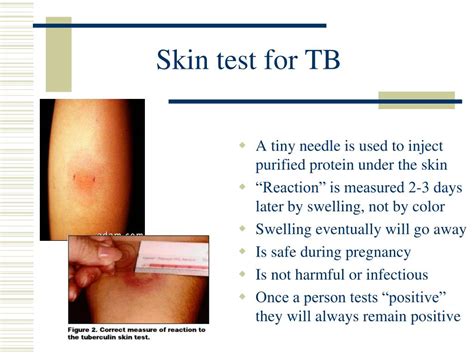 Ppt Tuberculosis Powerpoint Presentation Free Download Id6803376