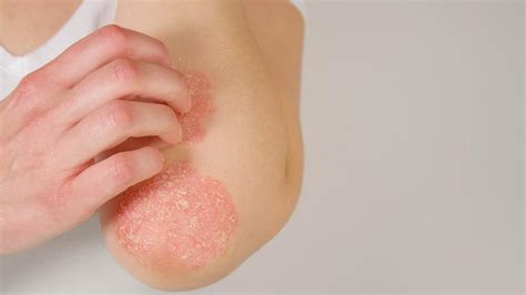 Encouraging Facts About Psoriasis Northstar Dermatology Dermatology