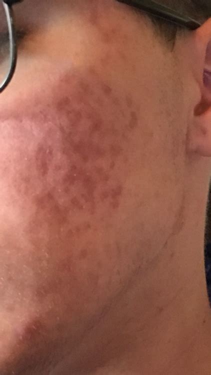 Acne Scarsmarks From Accutane Hyperpigmentation Reddark Marks