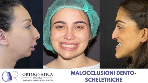 Chirurgia Ortognatica Le Malocclusioni Dento Scheletriche YouTube