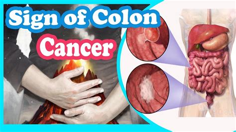 Warning Signs Of Colon Cancer Youtube