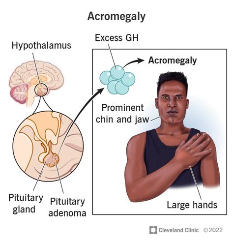 What Is Acromegaly Causes Pictures Signs And Symptoms Of Acromegaly