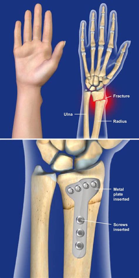 Fractured Ulna And Radius Bones