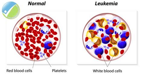 Leukemia Types Symptoms Causes Diagnosis And Treatment