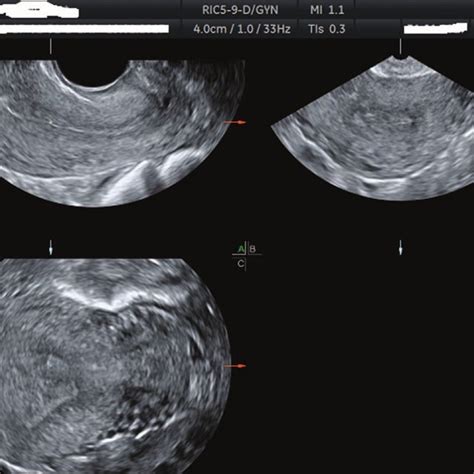 Three Dimensional Ultrasound Images In Coronal Plane Of U2a Uterine