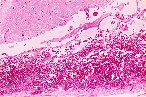 Anthrax Pathophysiology Wikidoc