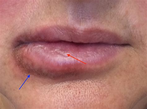 swollen bottom lip
