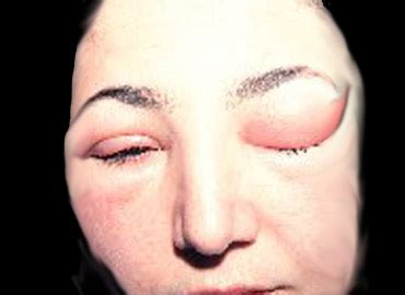 Los ojos son órganos muy sensibles y delicados. Dra. Odalys Vergara: Alergias en piel