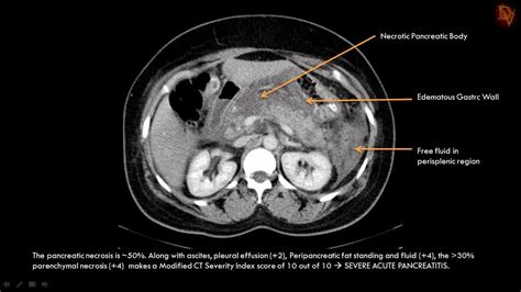 Ultimate Radiology Acute Necrotizing Pancreatitis
