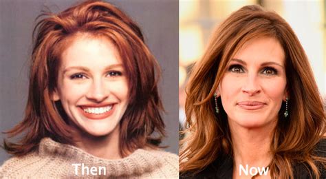 Julia Roberts Plastic Surgery Before And After Latest Plastic Surgery