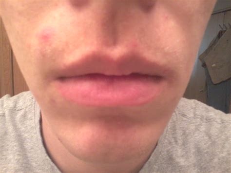 Main Problems Upper Lip Has Lots Of Tiny White Dots Along