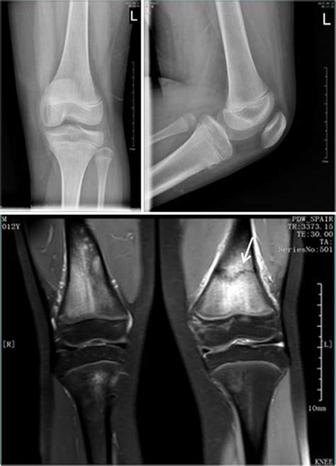 Frontiers Prevalence And Clinical Significance Of Occult Fractures In