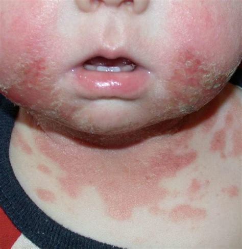 Cashew Allergy Skin Rash Babies Radqas