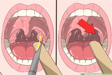What Is Tonsil Stones Definition Tonsil Infections Causes