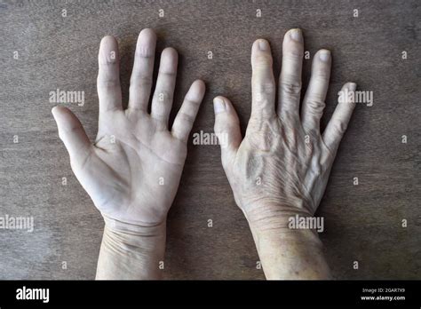 Pale Palmar And Dorsal Surfaces Of Both Hands Anaemic Hands Of Asian
