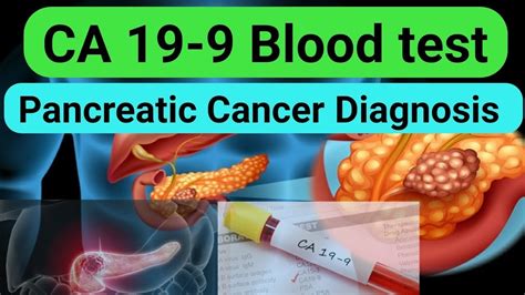 The aim of this prospective longitudinal study was the evaluation of ca19.9 levels in patients with chronic hepatitis and hepatic cirrhosis hepatitis c virus and b virus correlated. CA 19-9 - Bloedwaardentest