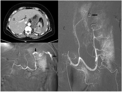 61 Year Old Woman With A Grade V Blunt Splenic Injury Underwent Distal