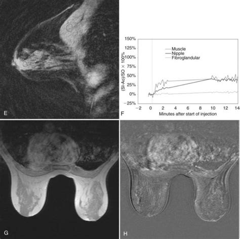 Magnetic Resonance Imaging Of Breast Cancer And Mri Guided Breast