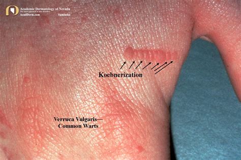 Warts Verruca Vulgaris Common Type Academic Dermatology Of Nevada