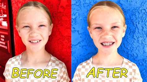 Madison Gets Braces Before And After Youtube