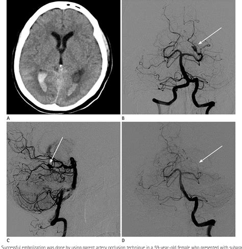 Table 1 From Distal Posterior Cerebral Artery Aneurysms Retrospective