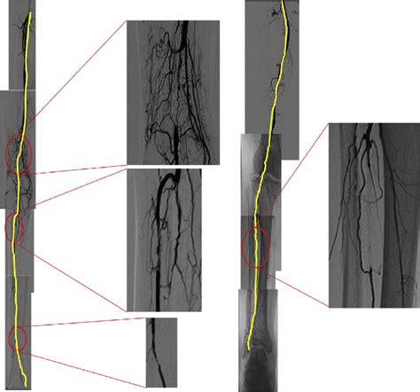 5 Representative Angiograms Of Global Limb Anatomic Staging System