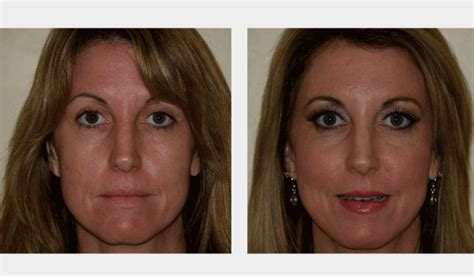 Face Fillers Injectables · Dr Schneider · Fort Myers Naples Cape Coral