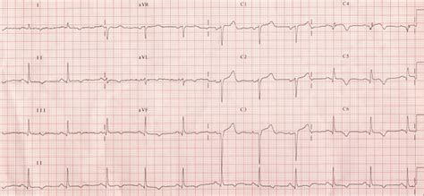 Old Anterior Wall Myocardial Infarction And Left Atrial Overload All