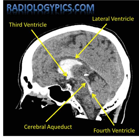 The Ventricular System Of The Brain Radiologypicscom