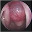 Case Of Tornwaldt’s Cyst Reported In NEJM
