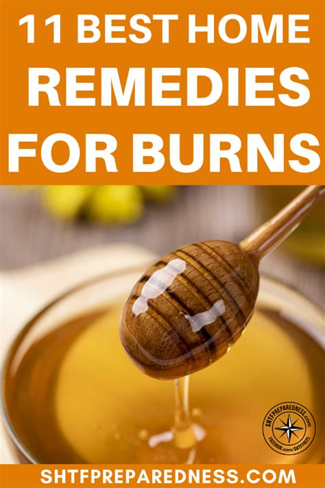 11 Best Home Remedies For Burns Recipe Home Remedies For Burns Burn Remedy Home Remedies
