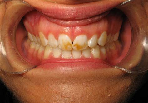 Tooth Discoloration Causes And Treatments Directorio Odontológico