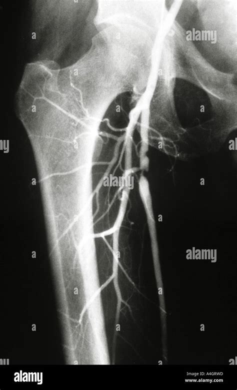 An Angiogram Also Called An Arteriogram Of The Leg Showing Stock
