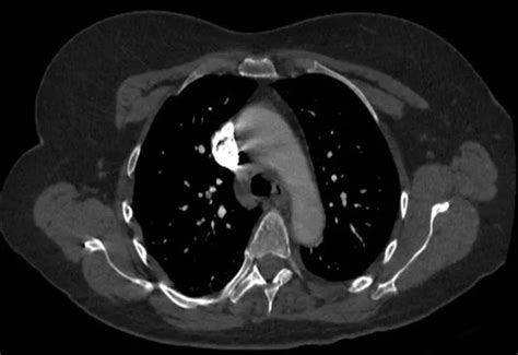 Subsegmental Pulmonary Embolism Prognosis And Treatment