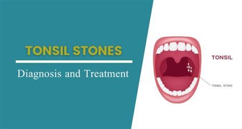Tonsil Stones Causes Symptoms And Treatment