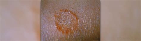 Bleach And Ringworm Does Bleach Kill Ringworm Quora Red Ring