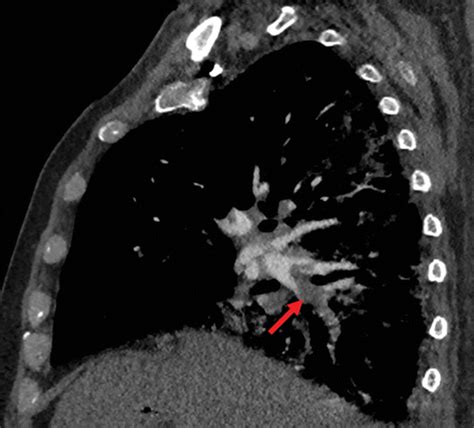 Chest Ct In Covid 19 What The Radiologist Needs To Know Radiographics