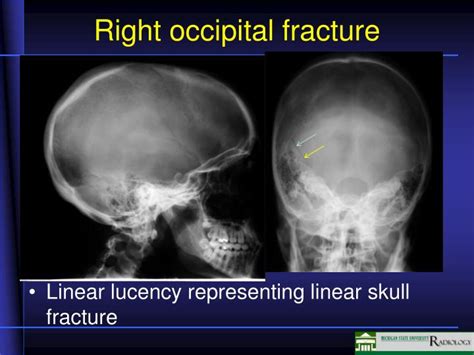 Left Occipital Skull Fracture