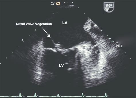 Transesophageal Echocardiogram Mitral Valve Vegetation Free Nude Porn