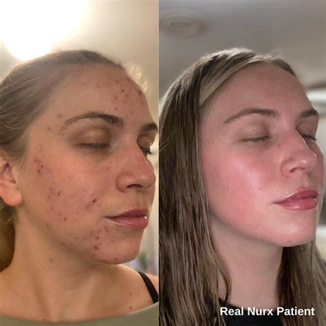 Tretinoin Cream Before And After