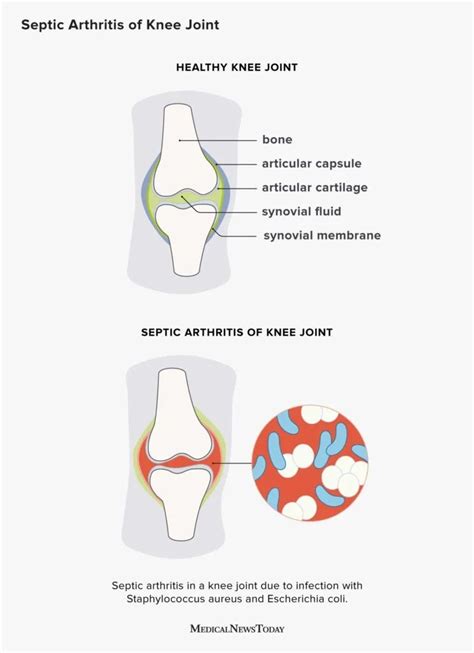 Osteoarthritis Knee Swelling