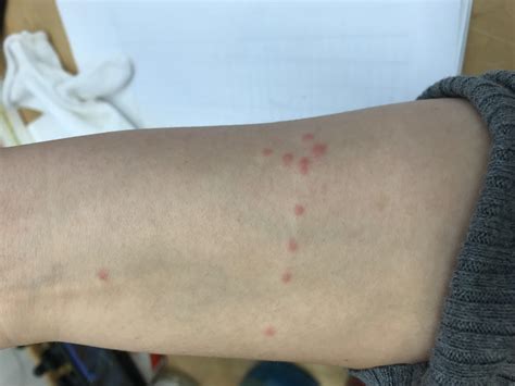Bed Bugs Bed Bug Bites Causes Symptoms Therapy Identification