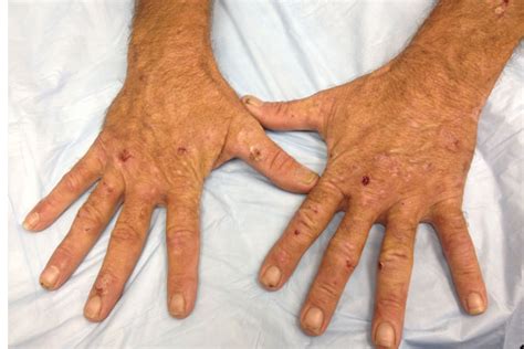 Derm Dx A Patient With Erosions And Reddish Urine Clinical Advisor