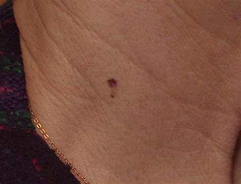 Pictures Of Melanoma On Leg Pictures Photos