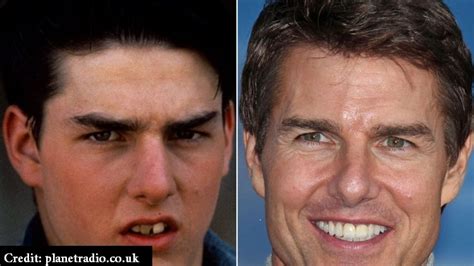 Tom Cruise Teeth Before After 10 Celebs Who Used To Have Horrible