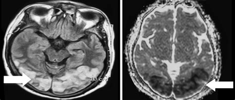 Brain Magnetic Resonance Imaging Showing Infarct In Bilateral Occipital