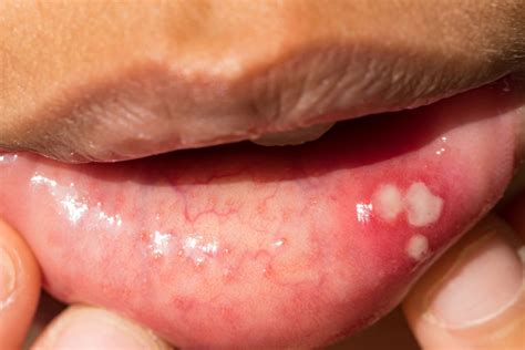 What Causes Canker Sores Symptoms Causes And Treatments Ph