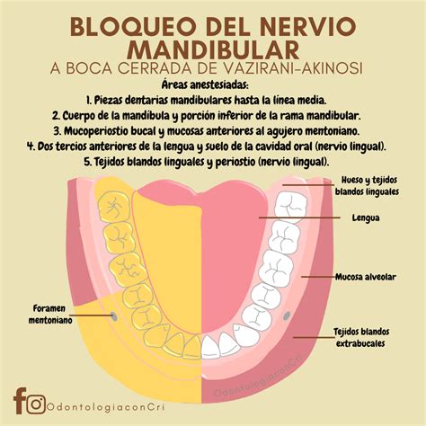 Bloqueo Del Nervio Mandibular Vazirani Akinosi Cavidad Oral